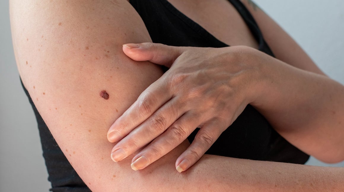 Udruženje oboljelih od melanoma u FBiH: vlast oduzima sredstva teško oboljelima